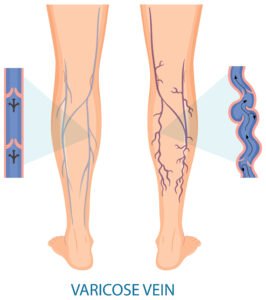 Human legs with varicose vein